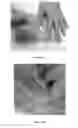 Fig. 06 - PERCUTANEOUS TUBE STABILIZATION DEVICE