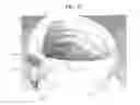 Fig. 45 - Systems and methods for shunting fluid