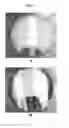 Fig. 09 - Solid forms of 1-ethyl-7-(2-methyl-6-(1H-1,2,4-triazol-3-yl)pyridin-3-yl)-3,4-dihydropyrazino[2,3-b]pyrazin-2(1H)-one, as TOR kinase inhibitors
