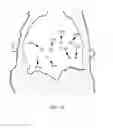 Fig. 20 - Medical fabric with integrated shape memory polymer