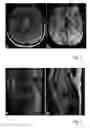Fig. 03 - MRI method of hybrid acquisition in 3D TSE
