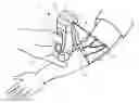 Fig. 01 - Patient-mounted micro vein enhancer
