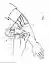 Fig. 02 - Patient-mounted micro vein enhancer