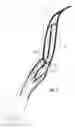Fig. 02 - Magnetically activated arteriovenous access valve system and related methods