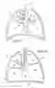 Fig. 02 - REMOVABLE ANCHORED LUNG VOLUME REDUCTION DEVICES AND METHODS