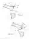 Fig. 06 - Instrumentation for knee resection