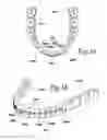 Fig. 02 - SYSTEM FOR MOVING AND ALIGNING TEETH