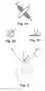 Fig. 02 - Implants, tools, and methods for treatments of pelvic conditions