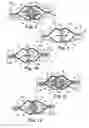 Fig. 09 - Implants, tools, and methods for treatments of pelvic conditions