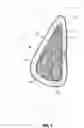 Fig. 02 - Lighter weight implant