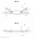 Fig. 09 - Intraocular lens
