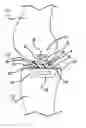 Fig. 01 - Convertible pre-partial knee replacement