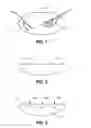 Fig. 02 - Methods and devices for patellar resurfacing treatment