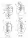 Fig. 02 - System and methods for internalization of external components of adjustable intragastric balloon