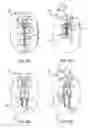 Fig. 03 - System and methods for internalization of external components of adjustable intragastric balloon