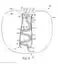 Fig. 05 - System and methods for internalization of external components of adjustable intragastric balloon