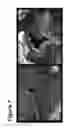 Fig. 08 - DEVICES AND METHODS FOR INHIBITING STENOSIS, OBSTRUCTION, OR CALCIFICATION OF A NATIVE HEART VALVE, STENTED HEART VALVE OR BIOPROSTHESIS