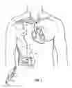 Fig. 02 - Methods and systems for counterpulsation of blood flow to and from the circulatory system