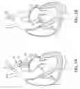 Fig. 02 - Percutaneous device and method for promoting movement of a bodily fluid