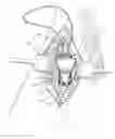 Fig. 01 - Methods for implanting subcutaneous vascular access ports