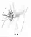 Fig. 08 - Methods for implanting subcutaneous vascular access ports