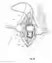 Fig. 09 - Methods for implanting subcutaneous vascular access ports