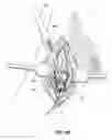 Fig. 16 - Methods for implanting subcutaneous vascular access ports