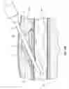 Fig. 20 - Methods for implanting subcutaneous vascular access ports