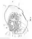 Fig. 32 - Methods for implanting subcutaneous vascular access ports
