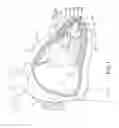 Fig. 02 - Leadless cardiac pacemaker with retrieval features