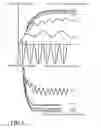 Fig. 02 - Pacemaker for unilateral vocal cord autoparalysis