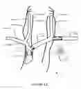 Fig. 17 - Transvascular nerve stimulation apparatus and methods