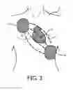 Fig. 04 - Defibrillation apparatus for wireless data exchange with a patient monitoring apparatus
