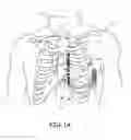 Fig. 02 - Implantable extravascular electrical stimulation lead having improved sensing and pacing capability