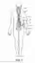 Fig. 02 - Implantable device with optical lead connector
