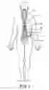 Fig. 02 - Implantable device with optical lead