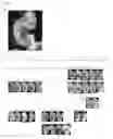 Fig. 07 - Targeting BCL11A distal regulatory elements for fetal hemoglobin reinduction