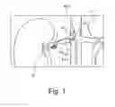 Fig. 02 - Digital Ruler and Reticule for Renal Denervation