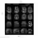 Fig. 06 - System, method and computer-accessible medium for joint magnetic resonance-positron emission tomography reconstruction using multi-sensor compressed sensing