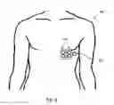 Fig. 07 - Wearable Device and Method for Assessing Cardiac Wellness by Analyzing High Definition EKG Signals