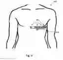 Fig. 09 - Wearable Device and Method for Assessing Cardiac Wellness by Analyzing High Definition EKG Signals