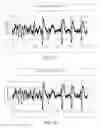 Fig. 08 - Use of a progressive compression encoding of physiologic waveform data in an implantable device to support discontinuing transmission of low-value data