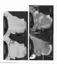 Fig. 04 - Methods, systems, and apparatus for identification, characterization, and treatment of rotors associated with fibrillation