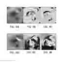Fig. 10 - ELECTROMAGNETIC SENSOR INTEGRATION WITH ULTRATHIN SCANNING FIBER ENDOSCOPE