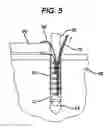 Fig. 05 - Knotless suture anchor