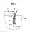 Fig. 07 - Knotless suture anchor