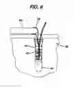 Fig. 08 - Knotless suture anchor