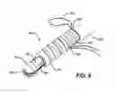 Fig. 09 - Knotless suture anchor