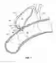 Fig. 02 - Anastomosis Devices