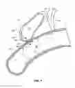 Fig. 02 - Anastomosis devices